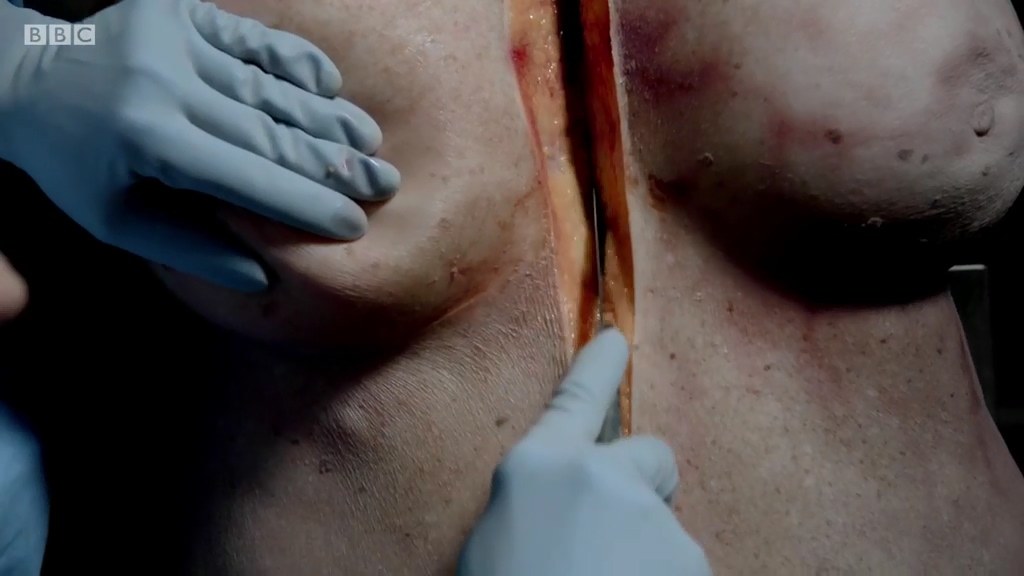 解剖肥胖剧照的剧照