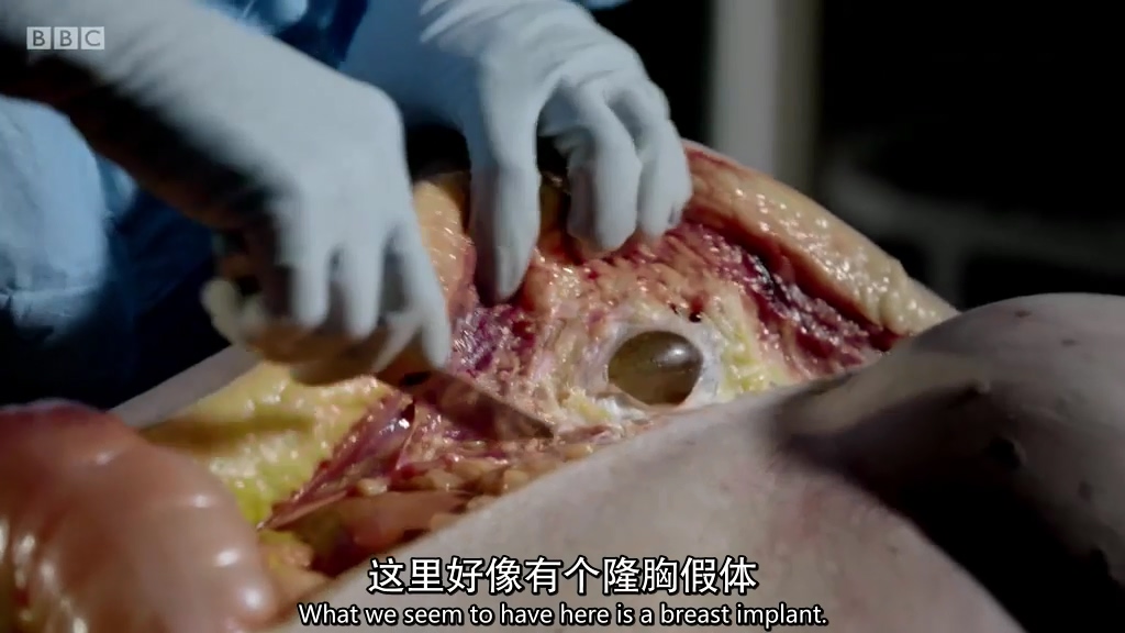 解剖肥胖剧照的剧照