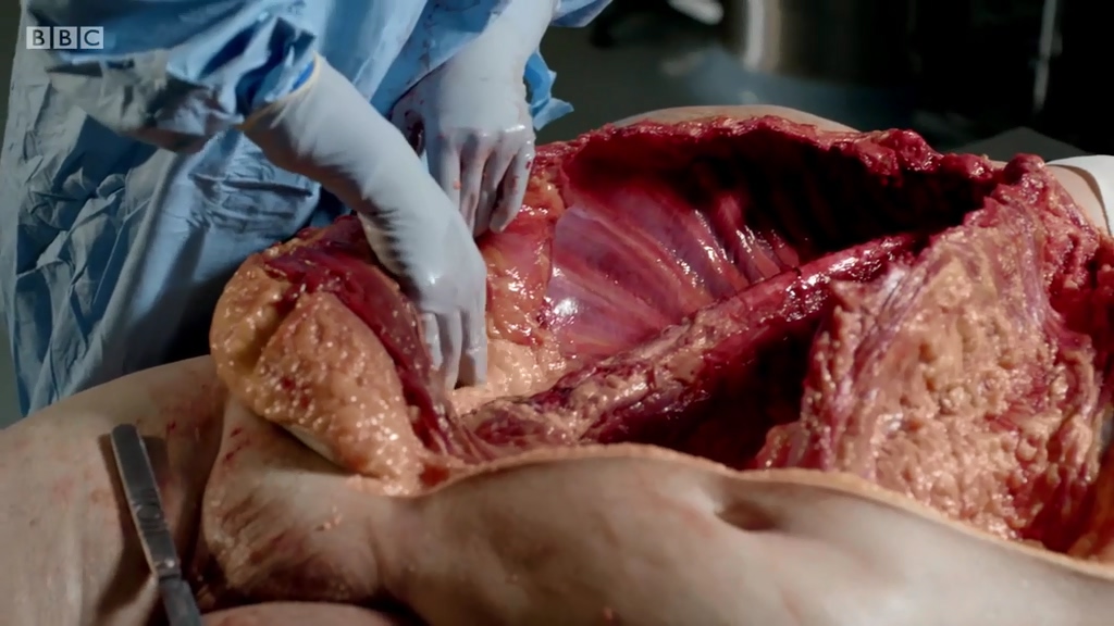 解剖肥胖剧照的剧照