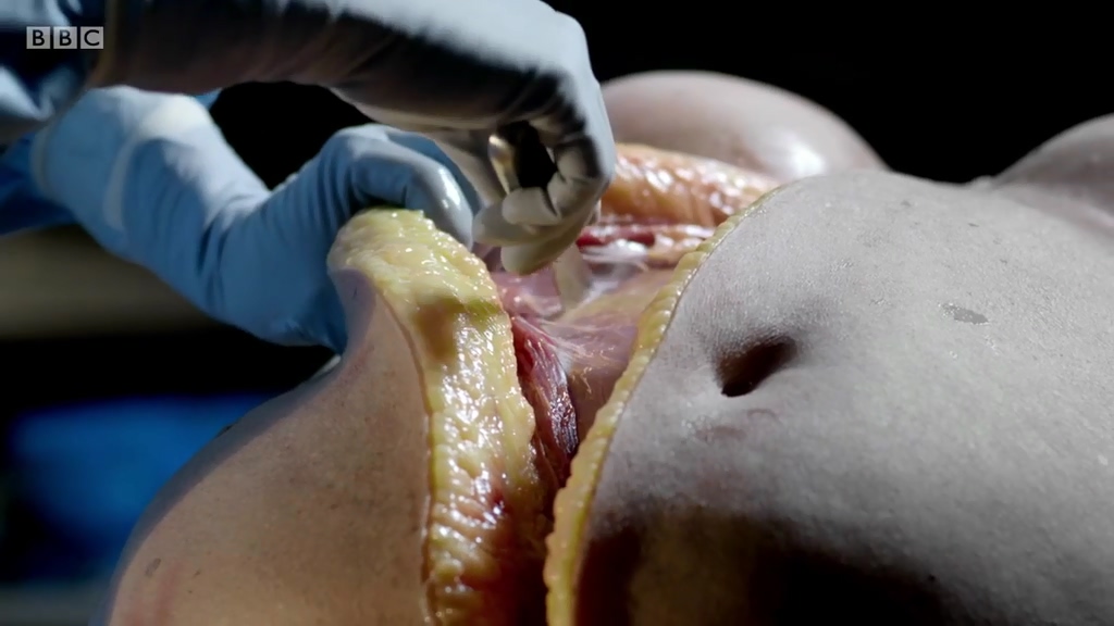 解剖肥胖剧照的剧照