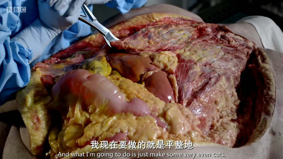 解剖肥胖剧照的剧照