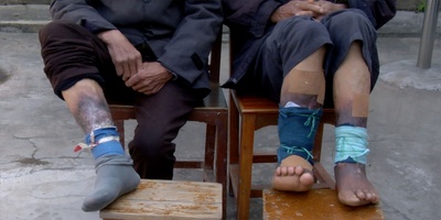 溃烂 愈合 掩藏剧照的剧照