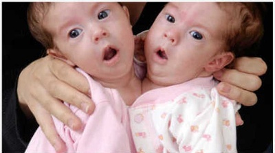 异于常人：连体人剧照的剧照